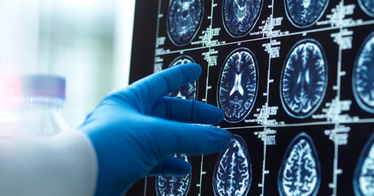 alzheimer egkefalos istock 1200x630.jpg