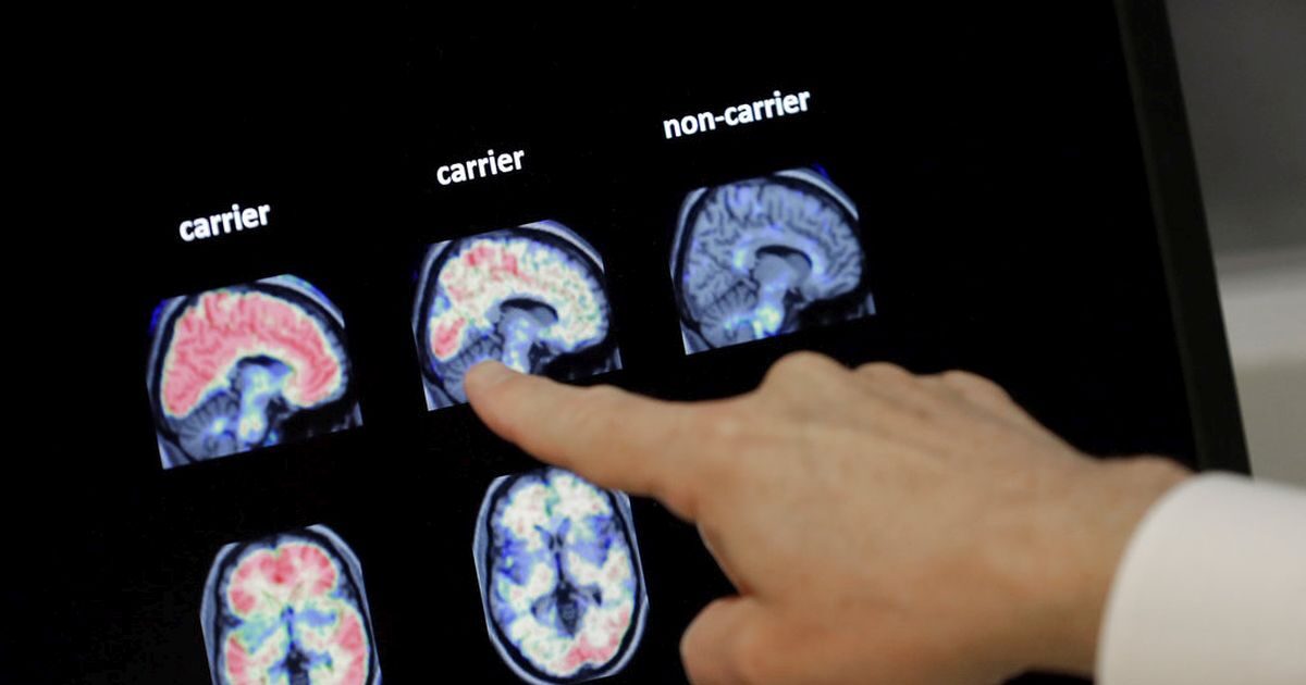 alzheimer 1200x630.jpg